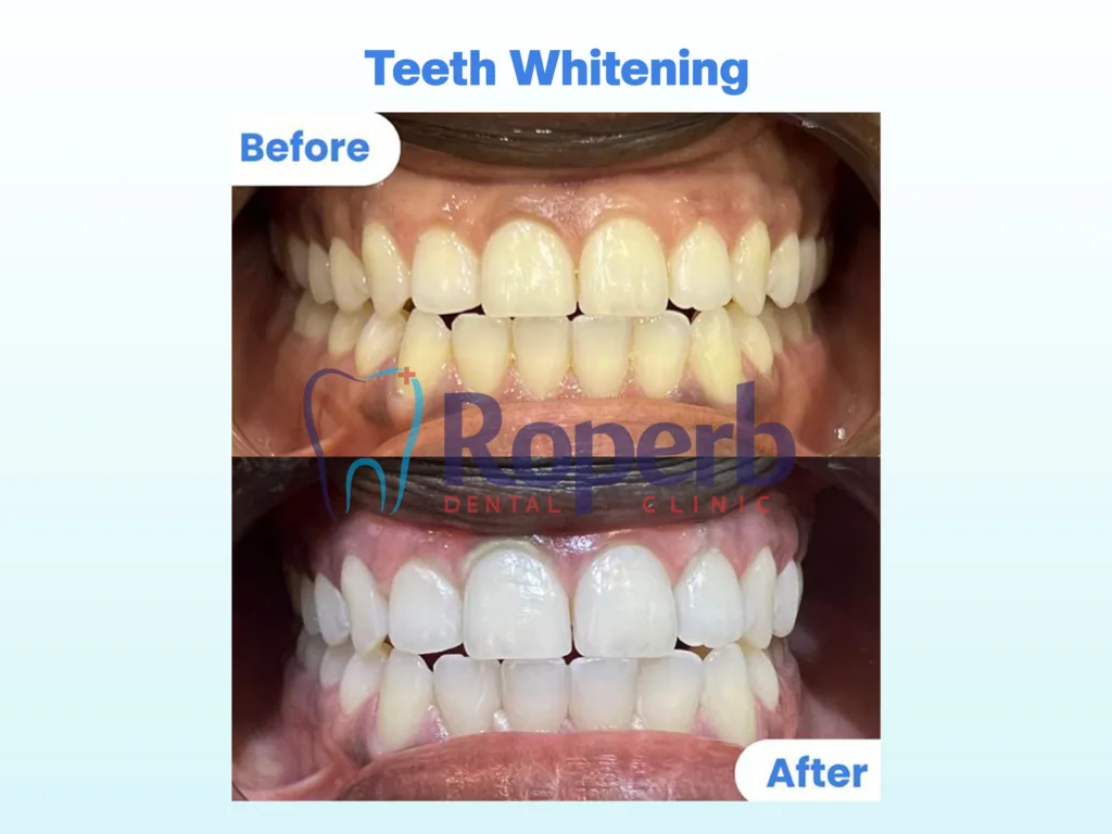 Teeth Whitening
